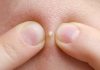Popping zits video